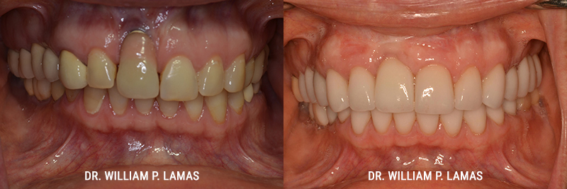 Dental Implants Repair Before & After Photo - William P. Lamas, DMD - Periodontics & Dental Implants. 